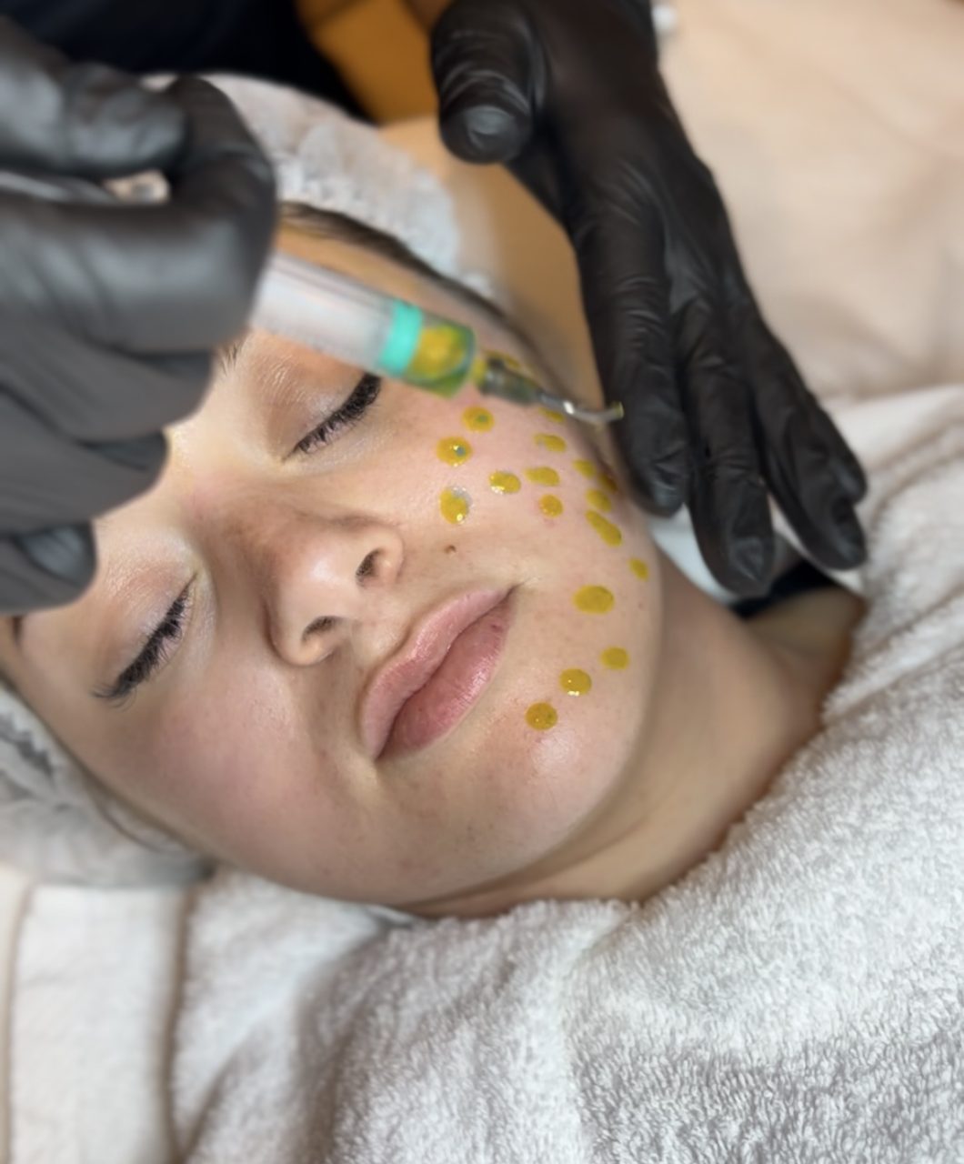 A specialized clinical aesthetician precisely applying a medical-grade chemical peel solution to treat skin texture and pigmentation issues at MV Beauty Art.